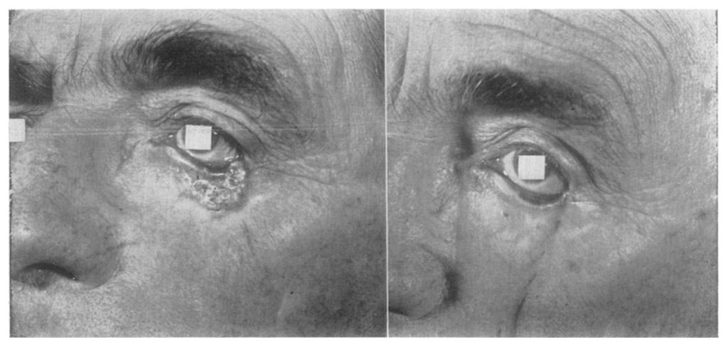 The excision necessitated removal of about one-third of the lower eyelid plus the inner canthus and I cm. of the upper eyelid.