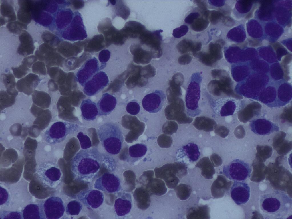 Results of FNA Non cohesive cells Typically