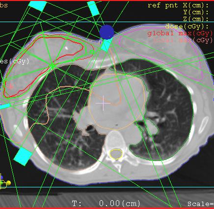 TRASTUZUMAB AND RADIATION (4) Radiation-associated cardiac damage occurs by both microvascular (fibrotic) and macrovascular (coronary