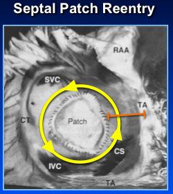 Reentrant Tachycardia Ablate the critical isthmus Ablation line anchors to