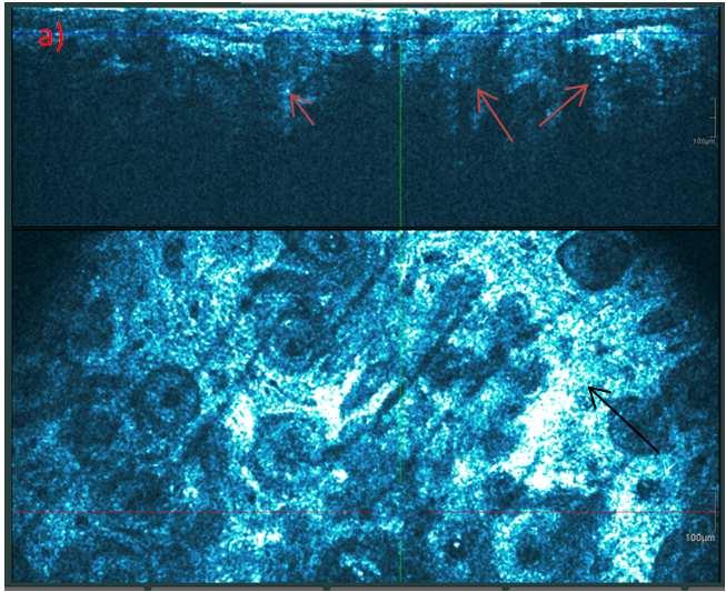 5 High optical coherence tomography for two thirds of the epidermis, and full thickness disarranged epidermal pattern was observed in AKs KIN III [14, 15].