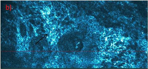 In the healthy skin, OCT vertical imaging reveals distinct layering of the epidermis stratum corneum, and dermis (Fig. 2).