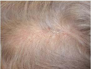 lesion on erythematous plaque on scalp Dry,