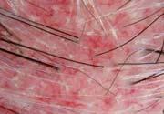Differentiating scalp psoriasis from other