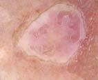 underdiagnosis of melanoma Users should receive
