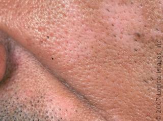 Deep Peel complications Altered pigment Adverse texture changes Scarring Milia, infection, skin