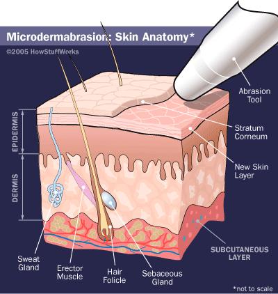 Microdermabrasion Developed in 1985 Mechanical procedure using a stream of fine abrasives (aluminum oxide crystals) Skin exfoliation to a