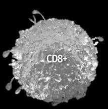 infiltratin f CD4+ and CD8+ T cells in 3/4