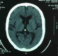 Romanian Neurosurgery (2016) XXX 4: 526 529 527 spinal or intracranial hemorrhages. Acute subdural hematoma complicating a lumbar puncture is rare.