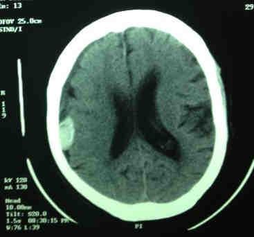 An excessive loss of CSP of about 250 cc may cause displacement of the intracranial structures.
