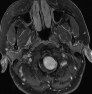 Large Dumbbell Shaped C1 Schwannoma Helms, Michael 33 Figure 1 Preoperative axial T1 weighted magnetic resonance imaging with contrast