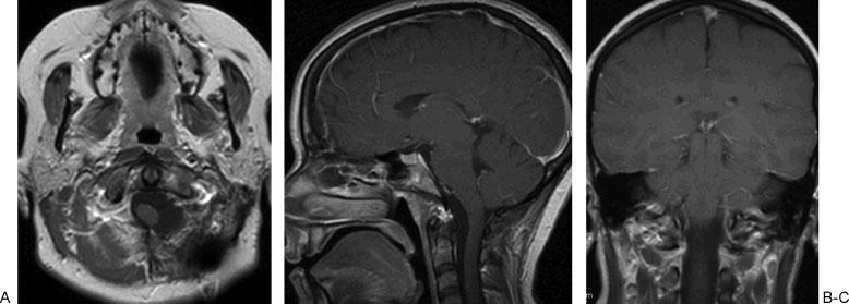 Large Dumbbell Shaped C1 Schwannoma Helms, Michael 35 Figure 7 Postoperative (A) axial, (B) sagittal, and (C) coronal T1 weighted magnetic resonance imaging without contrast shows no evidence of