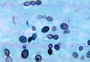 community-acquired fungal infections include Endemic dimorphic fungi Blastomyces dermatitidis Coccidioides immitis and C.
