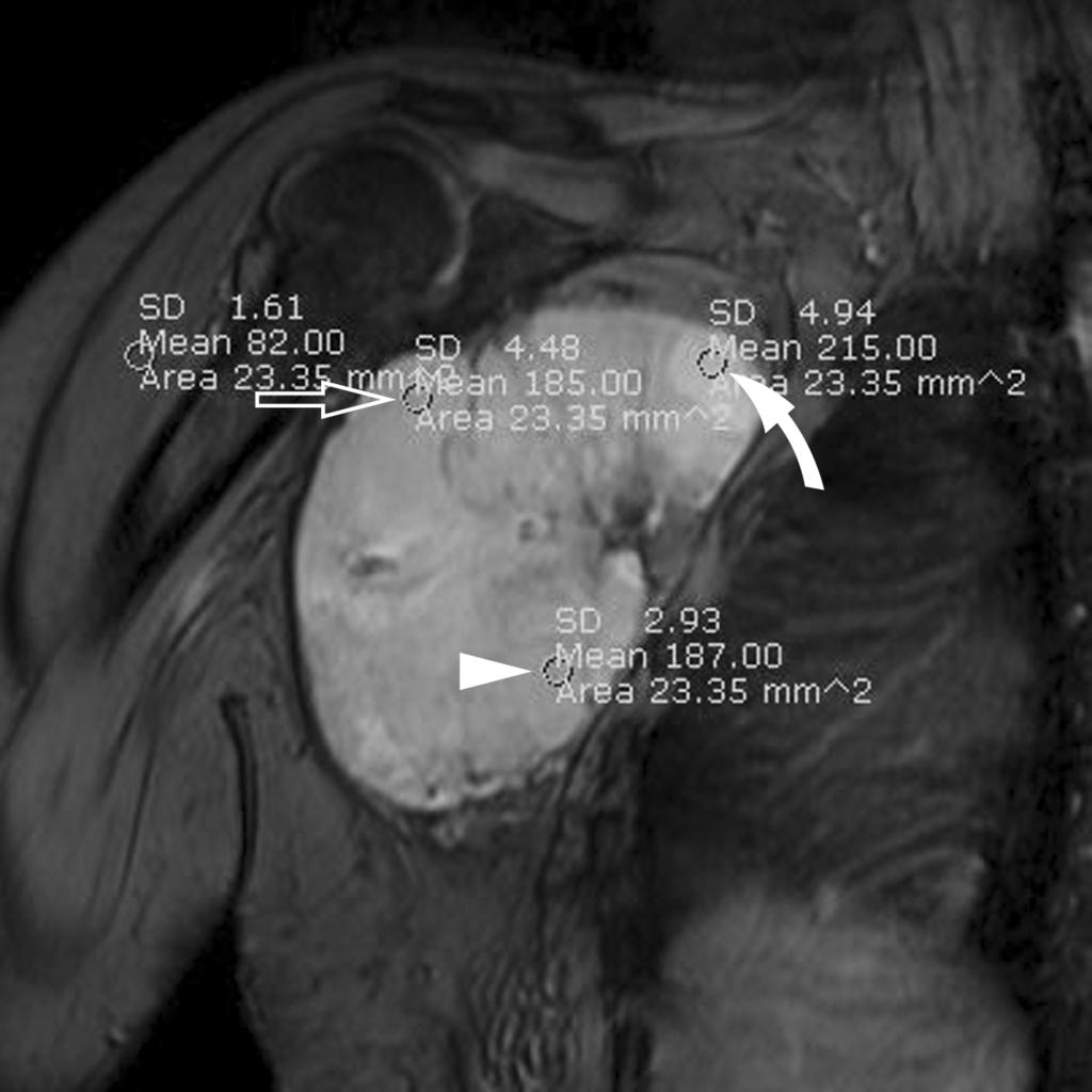 MRI Evaluation for the Histologic Components of Soft-tissue Tumors: Comparison of MEDIC and Fast SE T2-weighted Imaging liposarcoma (n = 1). The mean patient age was 36.