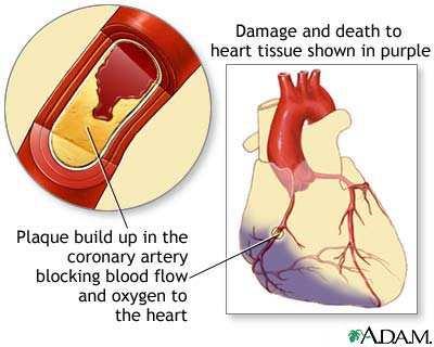 50% of the heart attack victims that survive will develop heart failure, a disease in which the heart is no longer able to pump a sufficient amount of blood into the body 18, 20. Figure 5.