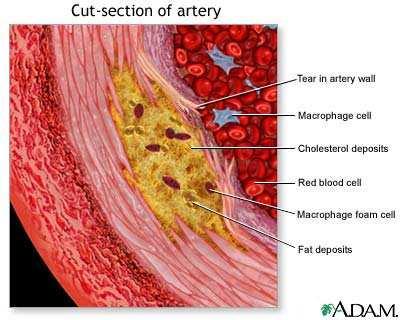 In atherosclerosis cholesterol accumulates in the blood vessel wall, causing an immune reaction that results in hardening of the tissue, thereby forming a plaque that and can eventually rupture.