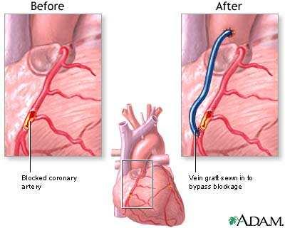 This can either be done via the implantation of a stent that opens the artery (left panel) or via bypass surgery, in which a blood vessel transplanted from elsewhere in the body takes over the