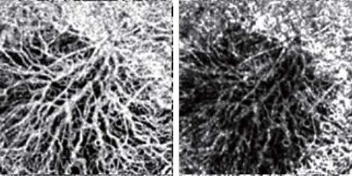 layers as well as choroidal vasculature. Fig. 5.