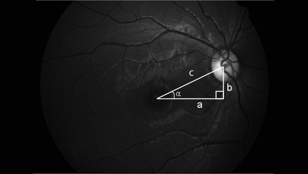 Korean J Ophthalmol Vol.27, No.1, 2013 amblyoscope, and an objective measuring test involving fundus photography.