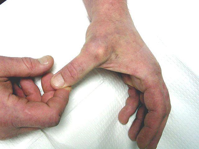 Gamekeeper s/ skier s thumb Injury to ulnar collateral lig of the 1st MCPJ, sometimes