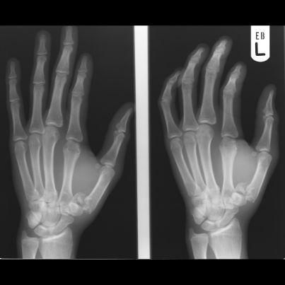 Bennett s Fracture Fracture at the base of the 1st Metacarpal.