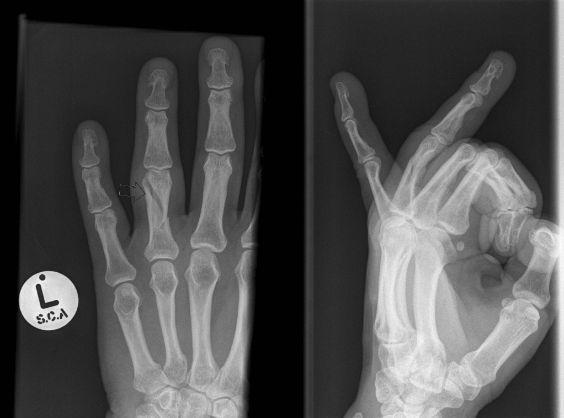 Phalangeal Fractures Distal Phalanx: Extra-articular fractures are common Intra-articular fractures are associated with extensor tendon avulsion Proximal