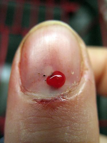 Management Analgesia Drain subuncal haematoma >50% Remove nail and explore if subuncal haematoma