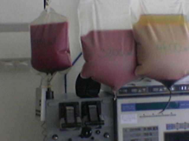 Leukemic white cell mass removed by cytapheresis from