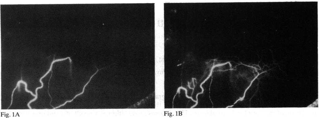 146 Fig. LA Figs. la, B, C Group 1A Anteriorsegmentfluorescein angiogram from a patient who had rheumatoid arthritis and a vascularised corneal gutter. (A) Early arterialphase.