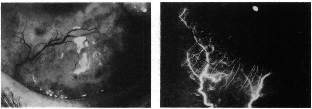Theproximal episcleral network is still unperfused. Fig. 1B Peter Watson and Sarah Booth-Mason Br J Ophthalmol: first published as 10.1136/bjo.71.2.145 on 1 February 1987. Downloaded from http://bjo.