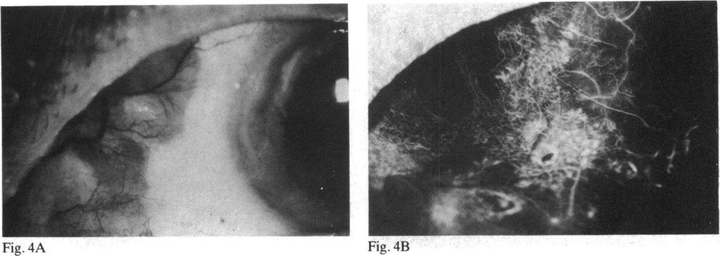 Fluorescein angiography in the differential diagnosis ofsclerokeratitis lig. 4A rig. 4LS Figs.