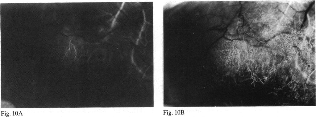 150 Peter Watson and Sarah Booth-Mason Fig. IOA Fig. lob Fig. IOA, B Group III A patient with a similar corneal appearance to Fig. 9.