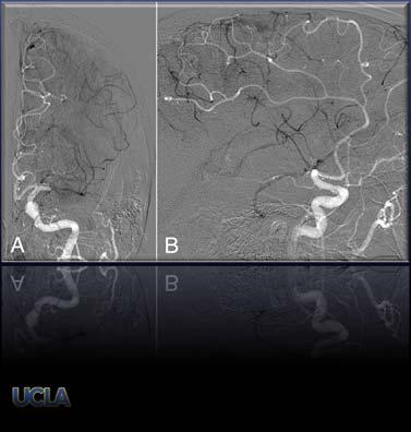 cerebral arteriogenesis process of collateralization pressure drop reverse flow increased shear stress cytokine release hypertension vascular remodeling imaging infrastructure serial imaging