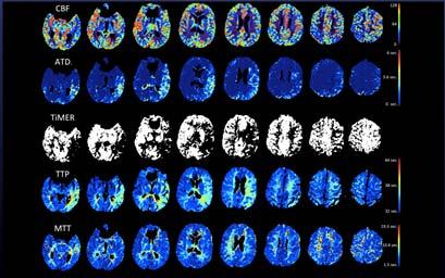 Malignant MRI pattern (8%) Predicts severe ICH following reperfusion Bayesian PWI