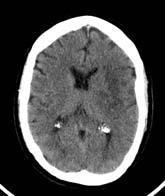 Angiogram IA Mechanical or Lytic Reperfusion Neuroprotectants Stroke Unit ASPECTS change from 8