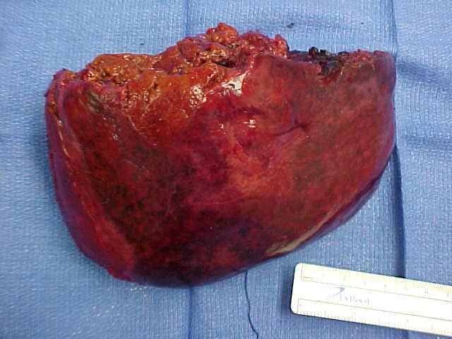 Liver Metastases N = 153 Colorectal 118 Intestinal 6