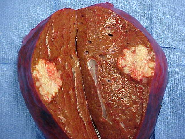 2 Liver Metastases from Colorectal Cancer Natural