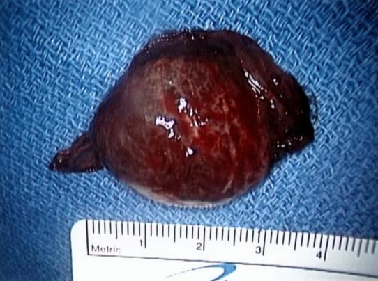 capsule, or the lesions become so large they press on surrounding organs Most lesions are asymptomatic and <4 cm in size Spontaneous rupture and hemorrhage, though serious, is quite rare (0-3%)
