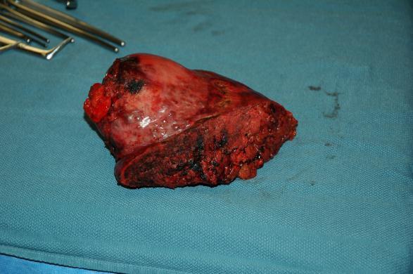 Tumor not otherwise resectable due to