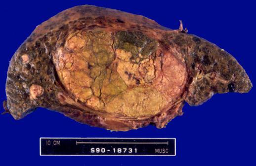 tumors, largest < 3 cm) Tumor <5 cm No
