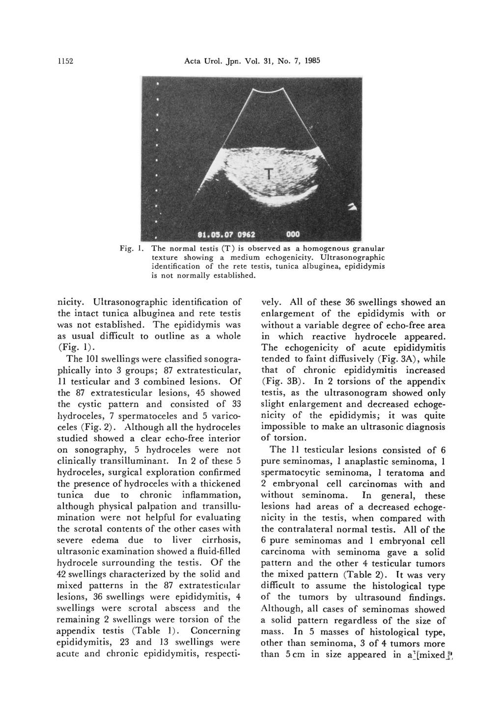 1152. Acta Urol. Jpn. Vol. 31, No.7, 1985 Fig. I. The normal testis (T) is observed as a homogenous granular texture showing a medium echogenicity.