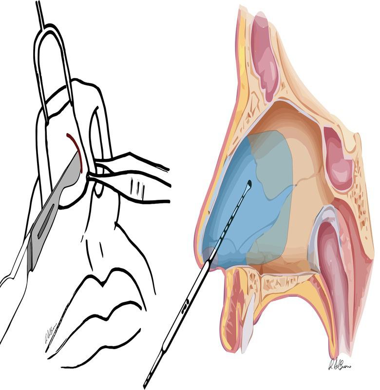 Page 2 of 9 Figure 1: Left: Right caudal incision performed to access the anterior nasal spine, maxillary crest, nasal floor, nasal dorsum and tip.