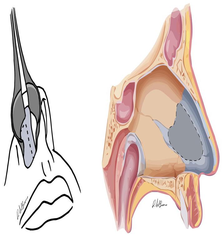 Page 6 of 9 Figure 10: Intra-operative (left) or a sagittal plane (right) view of the portion of cartilaginous septum that is resected (dashed line).