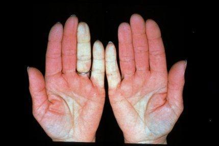 Disorders of the ANS Raynaud s disease: Characterized by constriction of blood vessels It is an exaggeration of vasomotor
