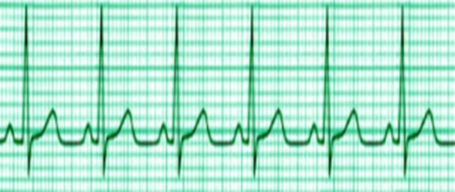 NEED FOR A DEFIBRILLATOR Ventricular fibrillation is a serious cardiac emergency resulting from asynchronous contraction of the heart