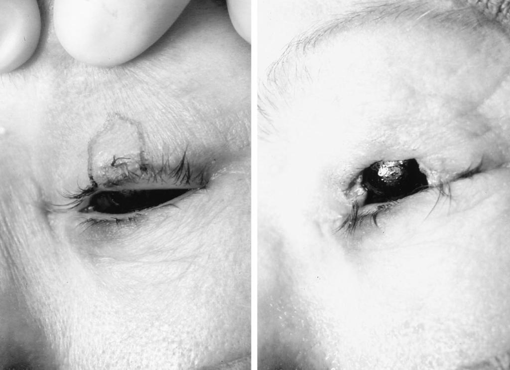 (Left) Outline of upper lid resection. (Right) Parallel full-thickness excision through tarsal plate.