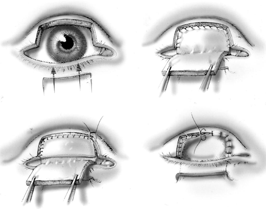 104e PLASTIC AND RECONSTRUCTIVE SURGERY, December 2004 total eyelid reconstruction (Fig. 8). An incision is made 5 mm inferior to the lower eyelid margin to preserve lid margin vascularity.