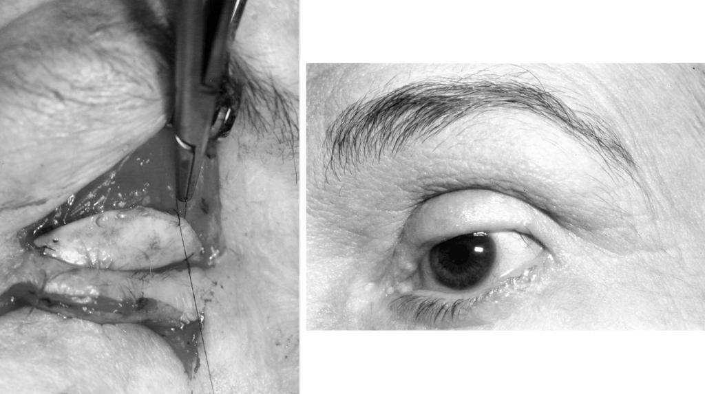 Right, final result after division of flap. FIG. 11. Lid sharing or Mustardé lid flap utilizes a two-stage transposition of the lower lid margin, including lashes.