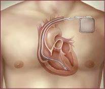 All ICDs have pacemaker capabilities Patients should carry device ID card and