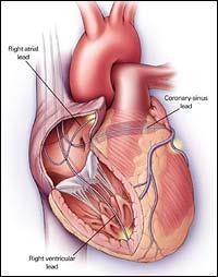 3 lead devices: RA RV LV via coronary sinus Indications (Class IIa): NYHA III or IV Receiving optimal medical